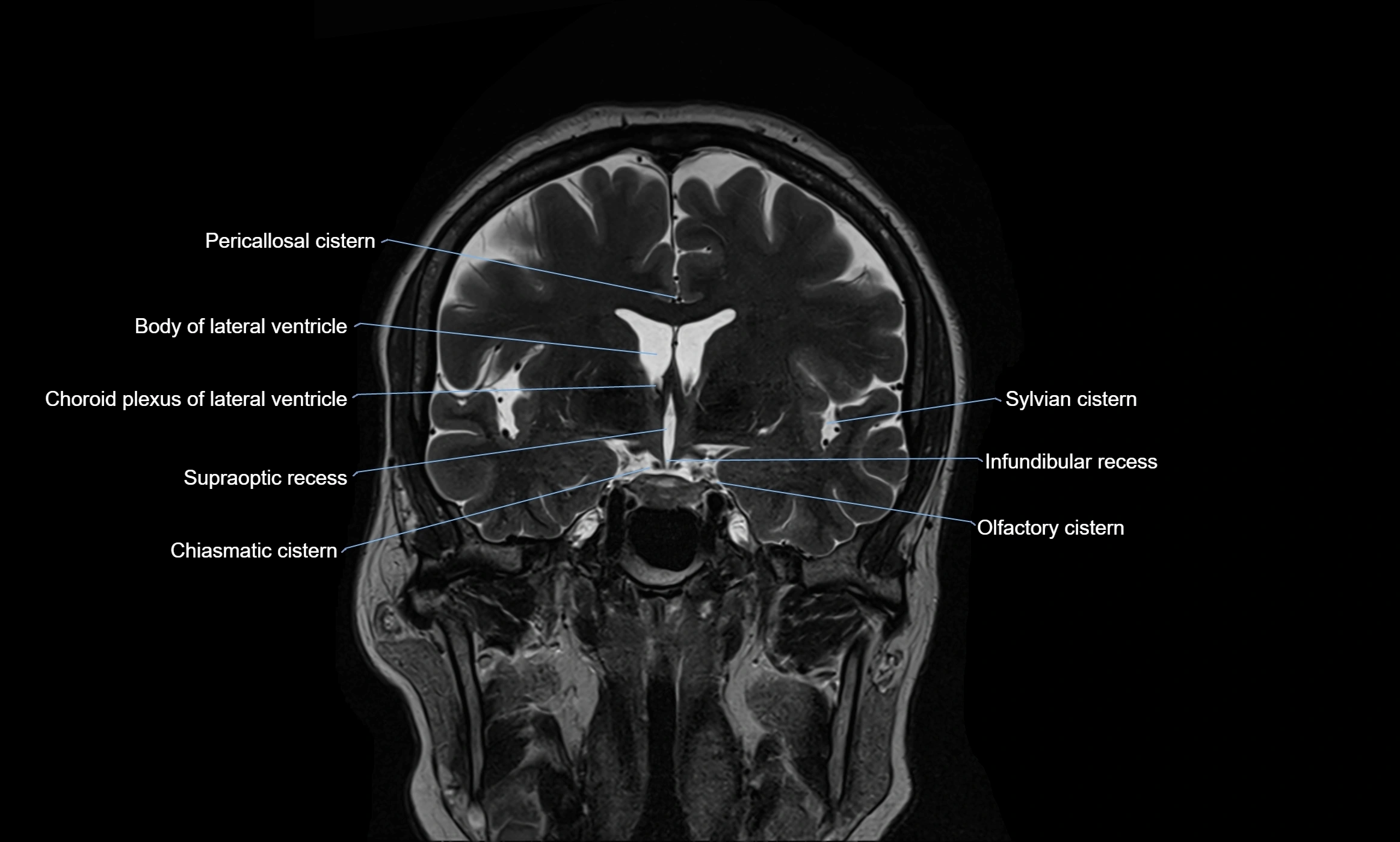 Brain cisterns  and ventricles coronal anatomy 3T MRI image-img-00001-00024.webp
